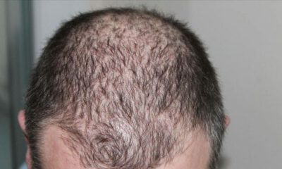 Kovid-19 sonrası saç dökülmelerinde artış…
