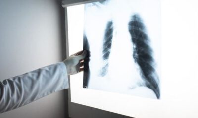 Akciğer kanseri, tüm kanser ölümlerinin yüzde 25’ini oluşturuyor