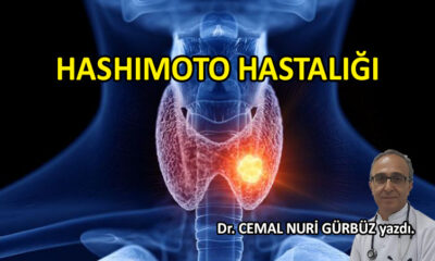 Hashimoto hastalığı